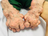 Quản lý tăng huyết áp ở bệnh nhân gout